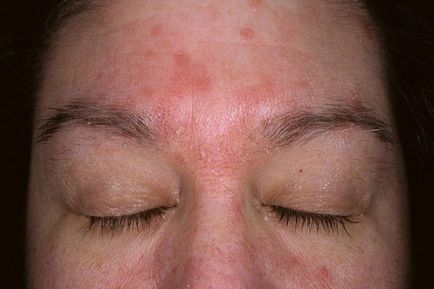 Псоріаз на обличчі особливості прояву хвороби, які бувають симптоми як і чим лікувати опис і