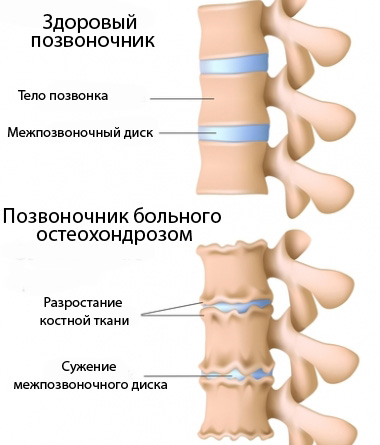 Радикуліт поперековий лікування мазями