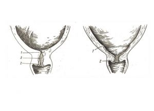 Dilatarea cervicală pentru 1 deget