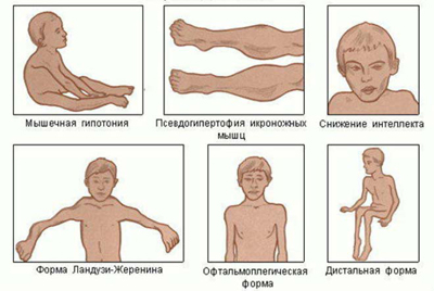 сортове миопатии