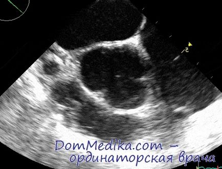 Rezoluția echocardiografică: axial, lateral, vertical