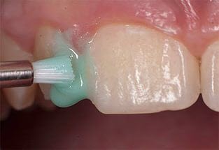 реминерализация зубів