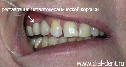 Ремонт відколу на металлокерамическом мостовидні протези зубів