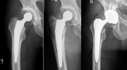 Revizia endoprosthetice a articulației șoldului, înlocuirea endoprotezei articulației șoldului