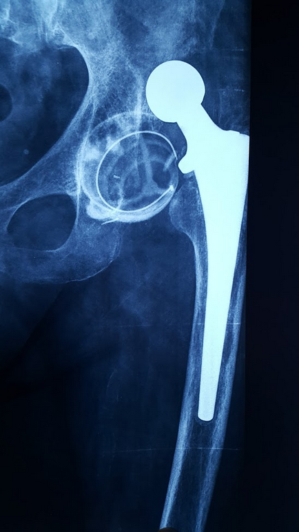 Revision hip arthroplasty csere csípő endoprotézis, (közös) Revision csípőprotézis, cseréje csípő endoprotézis,