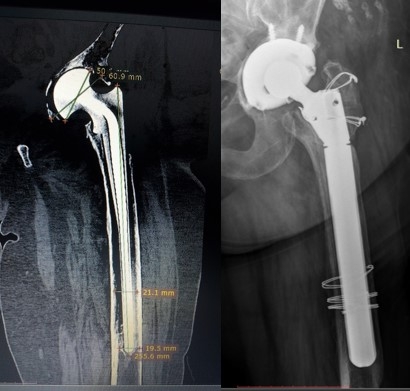 Revizia endoprosthetice a articulației șoldului, înlocuirea endoprotezei articulației șoldului