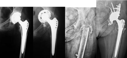 Revizia endoprosthetice a articulației șoldului, înlocuirea endoprotezei articulației șoldului