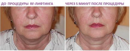 Rf-lifting facial tratament pentru pielea tinerească