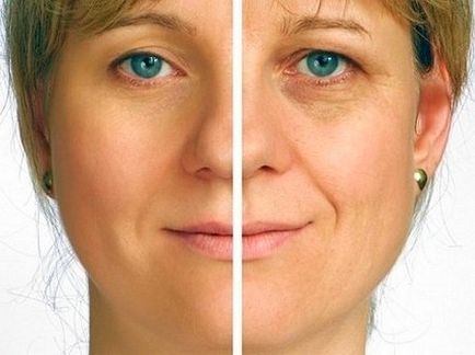 Rf-lifting facial tratament pentru pielea tinerească