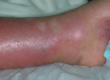 Erysipelas de piele tot ce trebuie să știți despre această boală