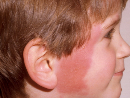 Erysipelas de piele tot ce trebuie să știți despre această boală