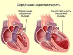 Insuficiența cardiacă este tratamentul fatal - tratamentul inimii