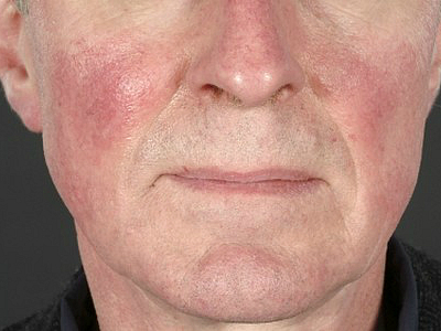 Лущення шкіри на обличчі у чоловіків причини і лікування