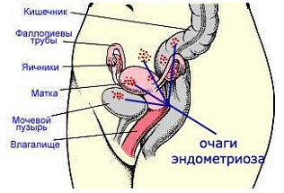 Симптоми, причини и лечение на ендометриоза