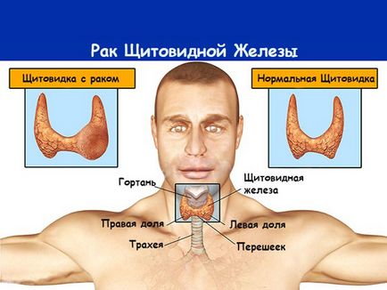 Câți trăiesc cu cancer tiroidian