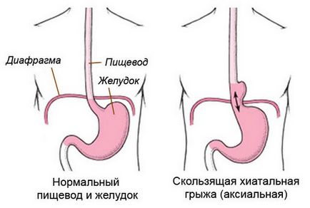 Змінна ГПОД причини, ознаки, симптоми, лікування