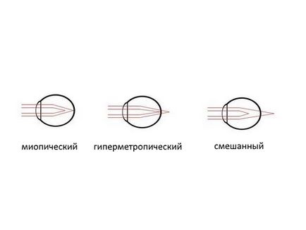 Складний гіперметропіческій астигматизм у дітей