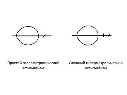 Складний гіперметропіческій астигматизм у дітей