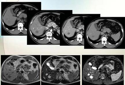 Realizări moderne în diagnosticul de radiații a carcinomului hepatocelular