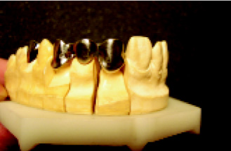 Сплави металів в сучасній стоматології