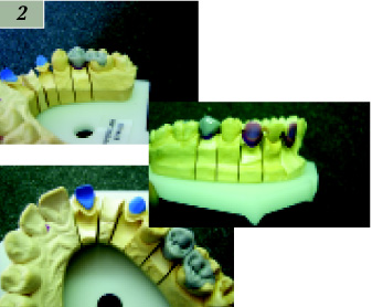 Сплави металів в сучасній стоматології