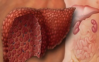 Etapele de ciroză hepatică, decompensare și stadiul final