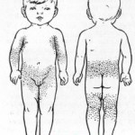 Febră stafilococică cum ar fi sindromul de tip scarlat - un pediatru - un loc pentru pediatri, interni,