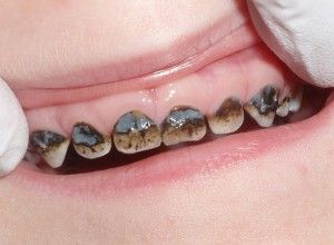 Темний наліт на зубах у дитини причини