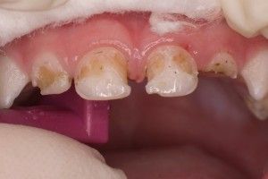 Темний наліт на зубах у дитини причини