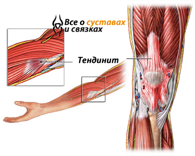 Tratamentul cu tendonite, simptome și tipuri