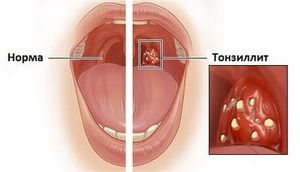Tonzilgon úgynevezett angina, torokgyulladás, mandulagyulladás gyermekek és felnőttek, vélemények