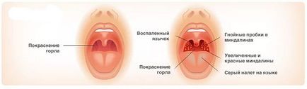 Тонзилгон н при ангіні, фарингіті, тонзиліті у дітей і дорослих, відгуки