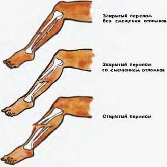 Удари, розтягування, вивихи, переломи, надання першої медичної допомоги при ДТП