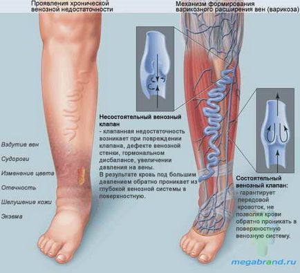 Tratamentul varicelor și prevenirea venelor, blog nsp