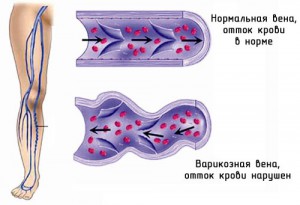 Варикозне розширення вен на ногах види операцій