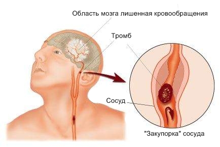 Tipuri de accidente vasculare cerebrale