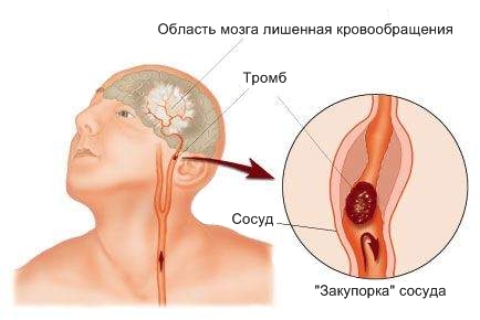 Típusai stroke (agyvérzés) típusú szélütés