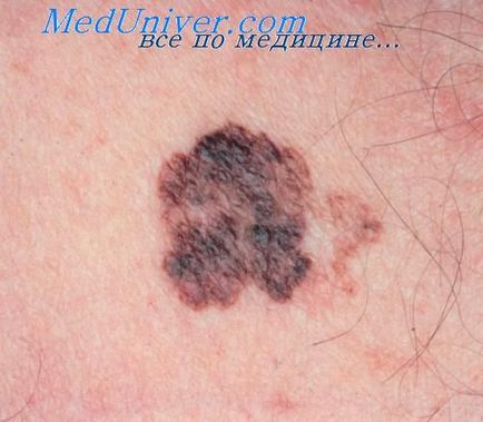 Tipuri de melanom