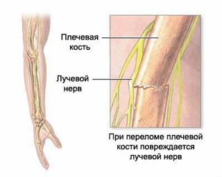 Típusai neuritis, tünetei az akut és krónikus idegi gyulladás okai