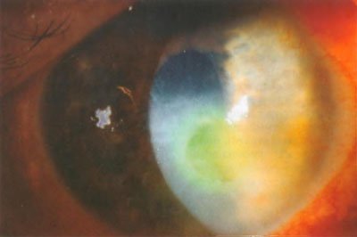 Herpes simplex vírus-eredetű neurotróf keratitis (szaruhártya-gyulladás metagerpetichesky)