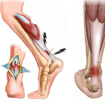 Inflamația tendonului lui Ahile
