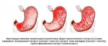 Gastroduodenita cronică - ce este, tipurile și simptomele din stadiul acut la copii, fotografii,