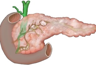 Pancreatita cronică - încredere în tratamentul diamantului