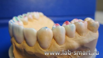 Laboratorul dentar inteligent, capabilitățile noastre, modelarea ceară