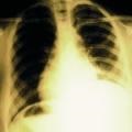 Abcesul și gangrena manifestărilor clinice și diagnosticului pulmonar