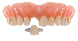 Адгезивний зубний міст, мостовидной протезування зубів, протезування зубів без обточування, методи