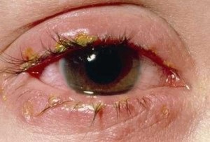 Алергічні захворювання очей - кон'юнктивіт симптоми і лікування