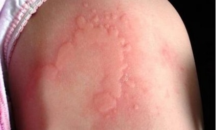 Алергія на холод - симптоми, лікування, причини