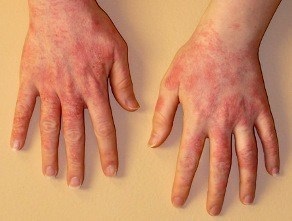 Алергія пальців рук - будьте здорові