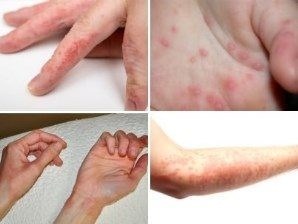 Alergia degetelor - fiți sănătoși